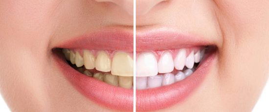 4 aliments qui blanchissent naturellement les dents